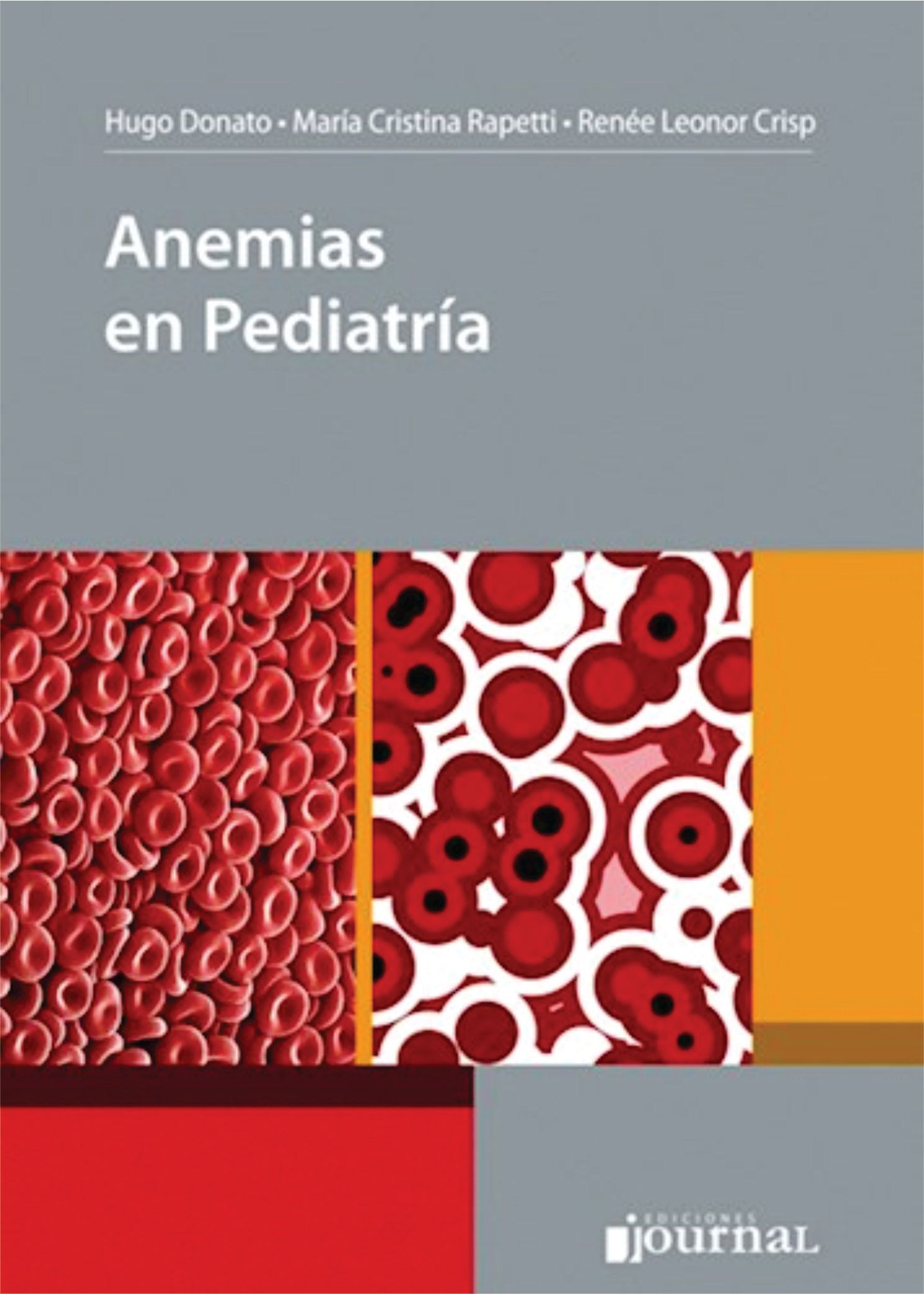 Anemias en Pediatría
